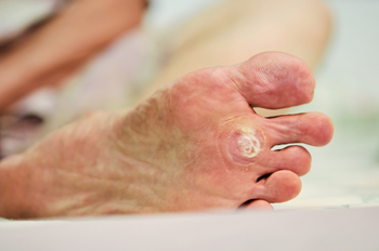 Human papillomavirus warts on feet